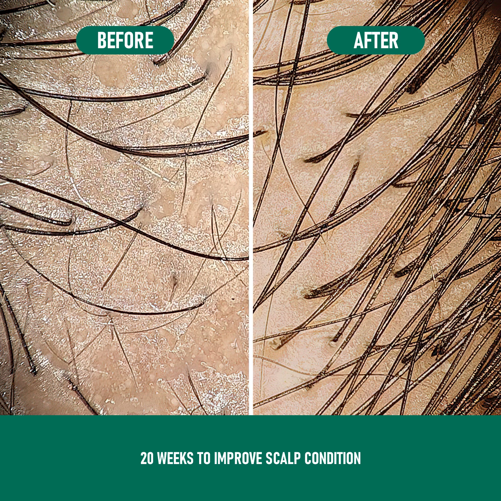 PHOFAY Minoxidil Topical Aerosol 5% (Foam) HAIR REGROWTH TREATMENT